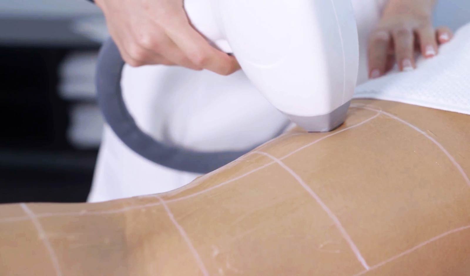 laser-treatment